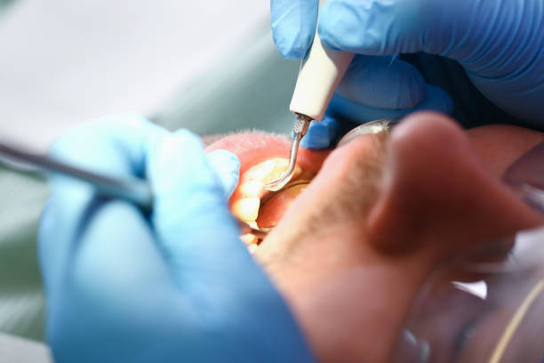 Best Emergency Root Canal Treatment in Chapman, KS